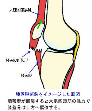 膝の打撲と挫傷