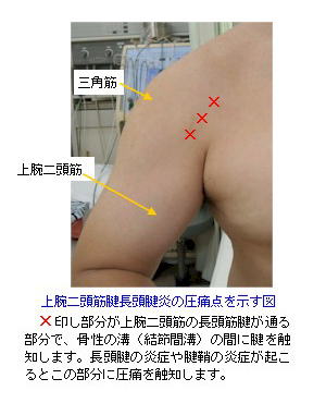 肩 上腕の打撲と挫傷