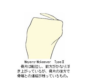 Meyers-Mckeever_Type2̉