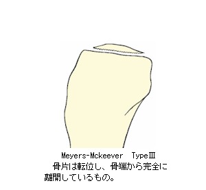 Meyers-Mckeever_Type3̉