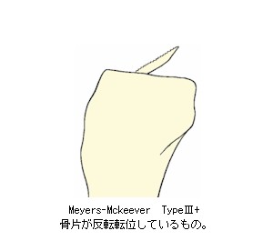 Meyers-Mckeever_Type3+̉