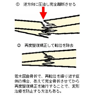 若木屈曲骨折の再転位とその対策解説２