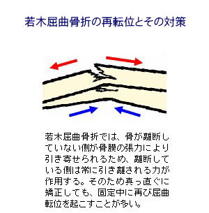 若木屈曲骨折の再転位とその対策解説１
