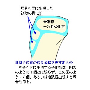 脛骨近位端成長軟骨略図４