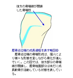 脛骨近位端成長軟骨略図６