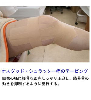 オスグッド・シュラッター病のテーピング