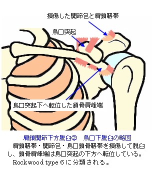 肩鎖関節下方脱臼　烏口下脱臼の略図_Rockwood_type6