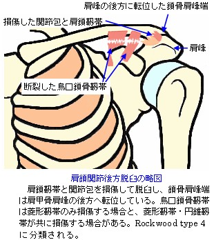 肩鎖関節後方脱臼_Rockwood_type4