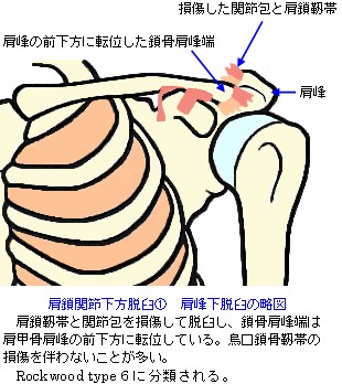 肩鎖関節下方脱臼　肩峰下脱臼の略図_Rockwood_type6
