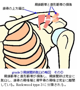 肩鎖関節脱臼の略図grade3_Rockwood_type3