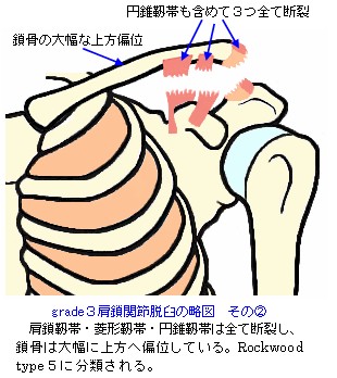 肩鎖関節脱臼の略図grade3_Rockwood_type5
