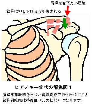 ピアノキー症状１