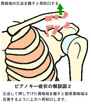 ピアノキー症状２