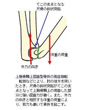 上腕骨顆上骨折