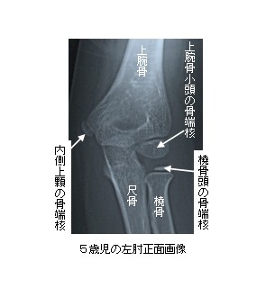 上腕骨外顆骨折 子どもの肘周囲の骨折