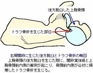 肩の脱臼 肩関節脱臼