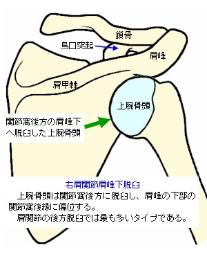 肩の脱臼 肩関節脱臼