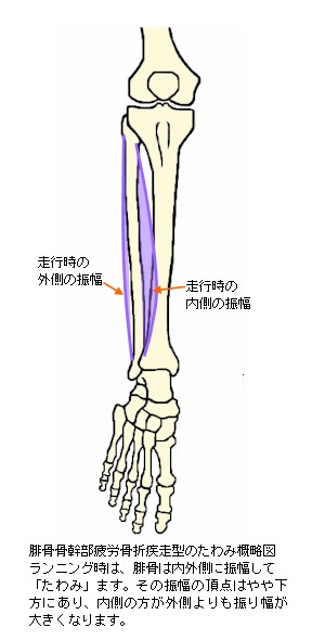 腓骨 疲労 骨折