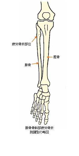 腓骨 疲労 骨折