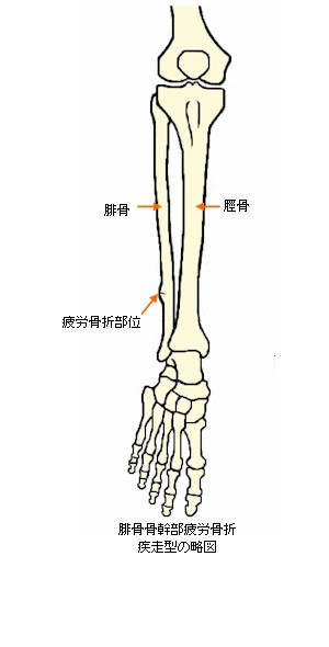 腓骨 疲労 骨折