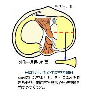 板 円盤 状 半月 円板状半月板