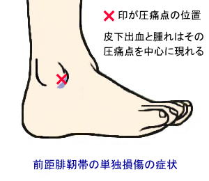 靭帯 踵 腓 足関節の靭帯損傷を評価するコツ！ ～踵腓靭帯（CFL）・前下脛腓靭帯（AITFL）編～｜Y.K｜note