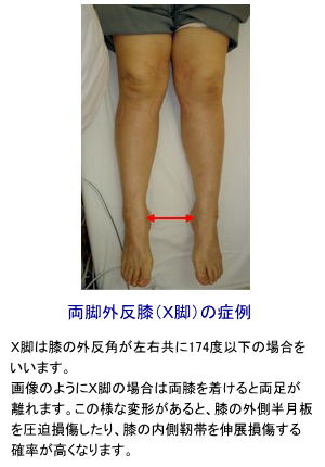 膝関節の構造と膝関節捻挫