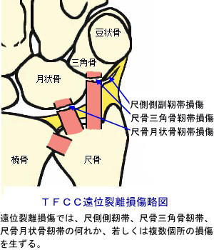 TFCCʗ